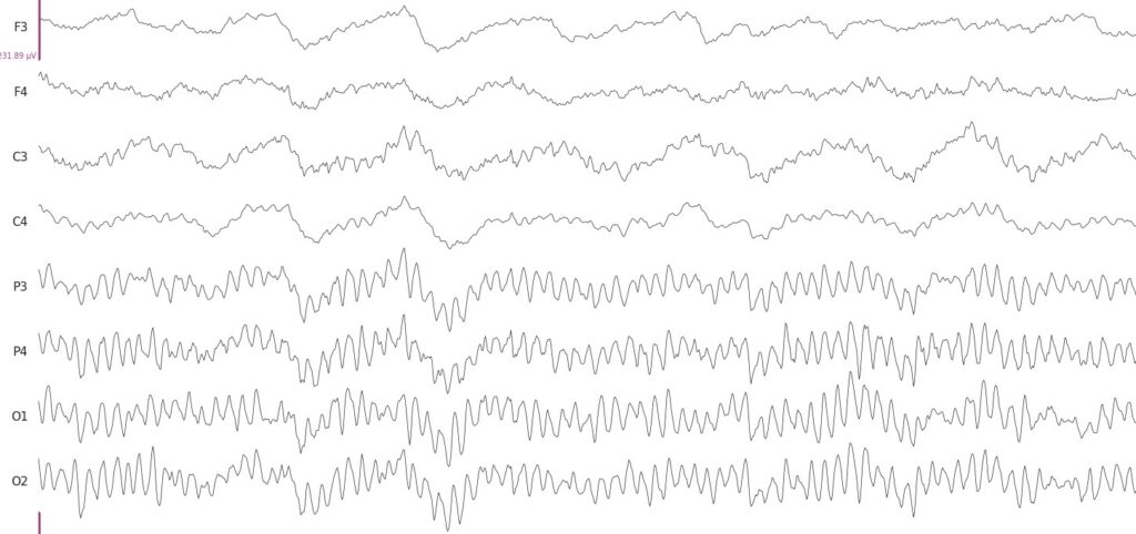 EEG signals when a person has their eyes closed. The alpha rhythm can be observed in P3-O2 electrode recordings, that are over the occipital cortex region